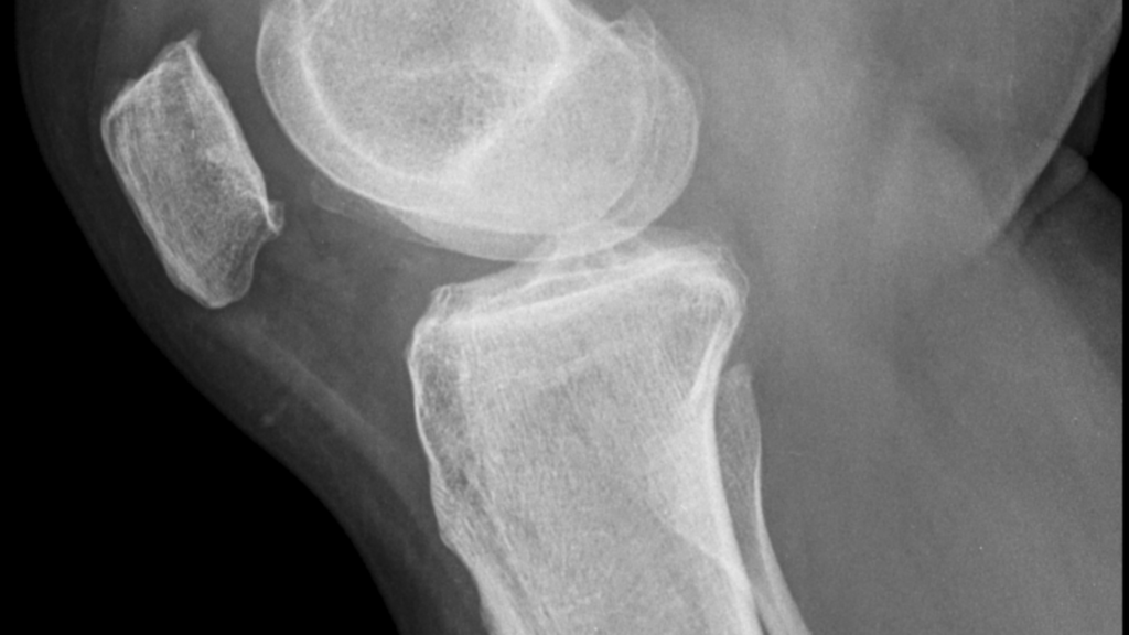 Injuries Commonly Seen in a Mustang Ridge Rollover Crash